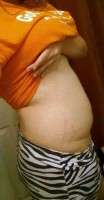 Tummy tuck after giving birth image