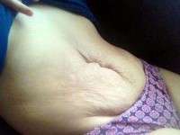 Tummy tuck after giving birth photos