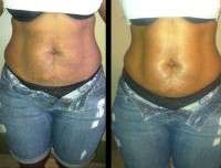 Tummy tuck alternative laser before and after