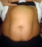 Tummy tuck and pregnancy photo