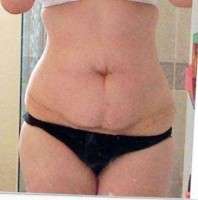 Tummy tuck before after scars image