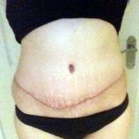 Tummy tuck before after scars photos