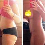 Tummy tuck before and after pregnancy