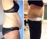 Tummy tuck before and after scars image