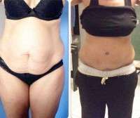 Tummy tuck before and after scars images