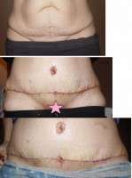 Tummy tuck before and after scars photos