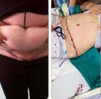 Tummy tuck before and after scars picture