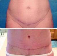 Tummy tuck before and after scars pictures