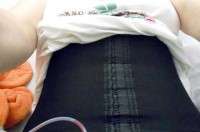 Tummy tuck compression garment image