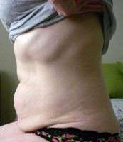 Tummy tuck for loose skin image