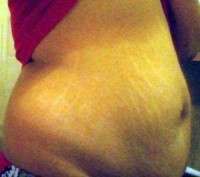 Tummy tuck for stretch marks image