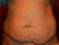 Tummy tuck for stretch marks images