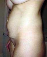 Tummy tuck loose skin photo