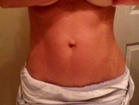 Tummy tuck mommy makeover image