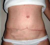 Tummy tuck numbness picture