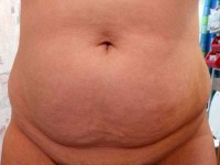 Tummy tuck or liposuction question