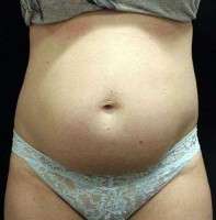 Tummy tuck post pregnancy photo