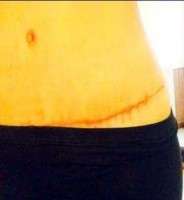 first day day by day tummy tuck recovery
