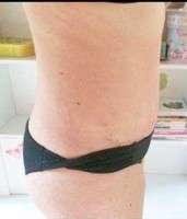 Tummy tuck recovery stories photos