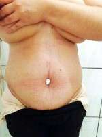 Tummy tuck recovery swelling image