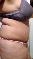 Tummy tuck recovery swelling picture