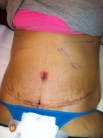 Tummy tuck risks and complications photo
