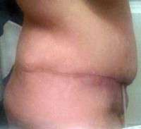 Tummy tuck scar after 1 year picture