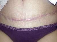 day by day tummy tuck recovery