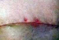 Tummy tuck scar post op swelling