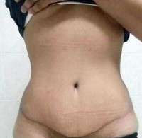 Tummy tuck scars after 2 years image
