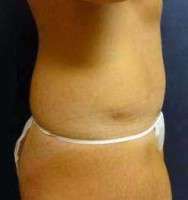 Tummy tuck scars after 2 years pictures