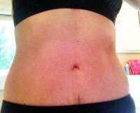 Tummy tuck stretch marks images