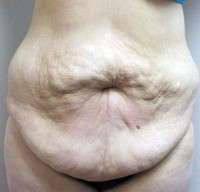 Tummy tuck surgery after birth