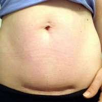 Tummy tuck surgery after c section