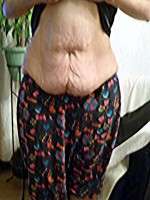 Tummy tuck surgery cost how much