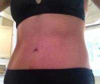 Tummy tuck surgery for stretch marks