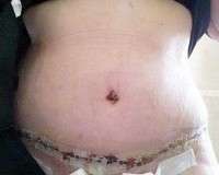 Tummy tuck surgery scars image