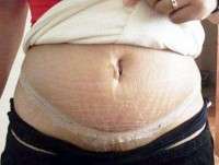 Tummy tuck surgery scars images