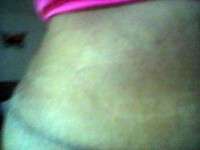 Tummy tuck surgery scars photos