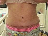 Tummy tuck surgery swelling after 4 weeks