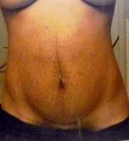 Tummy tuck surgery to get rid of stretch marks