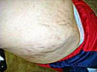 Tummy tuck surgery to remove stretch marks