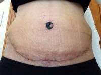 Tummy tuck surgery without drains