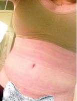 Tummy tuck swelling after 4 week