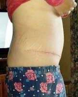 Tummy tuck swelling after three months