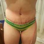 Tummy tuck swelling images