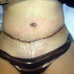 Tummy tuck swelling photo