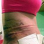 Tummy tuck swelling picture