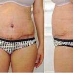 Tummy tuck swelling scar images