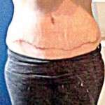 Tummy tuck swelling scar pictures
